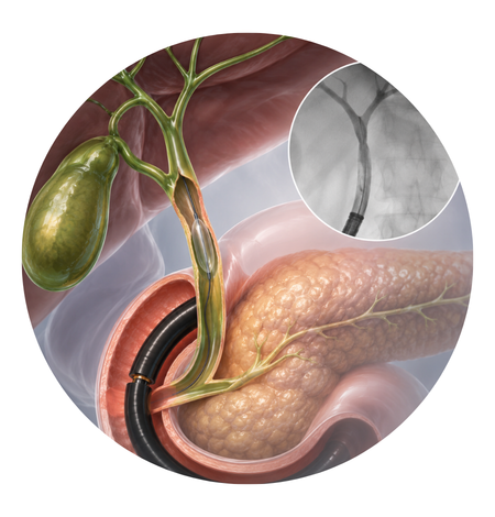 Biliary Stricture Assessment